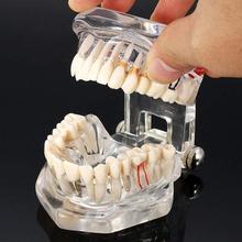 牙齿模型 透明可拆卸理种植牙模型 连桥牙髓演示模型