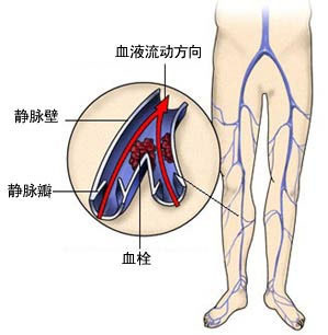 2,游走性浅下肢静脉炎初期表现局部皮肤红,肿,热,痛,可触及皮下硬结或