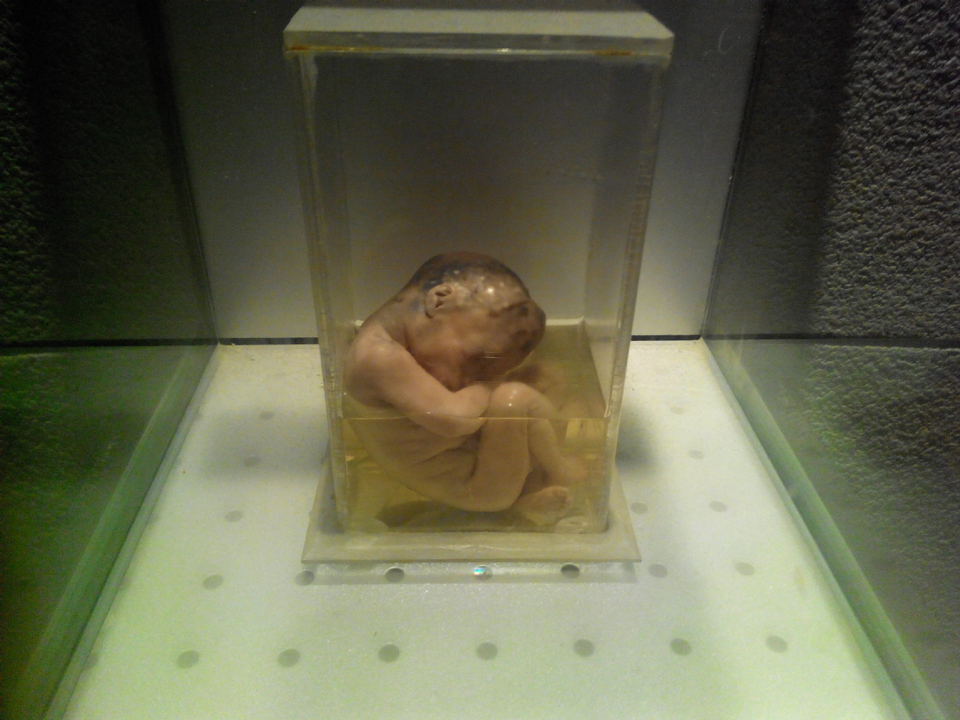 因父母吸毒形成的畸胎(相当恐怖)