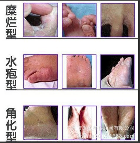 要保持脚的清洁干燥,汗脚要治疗.