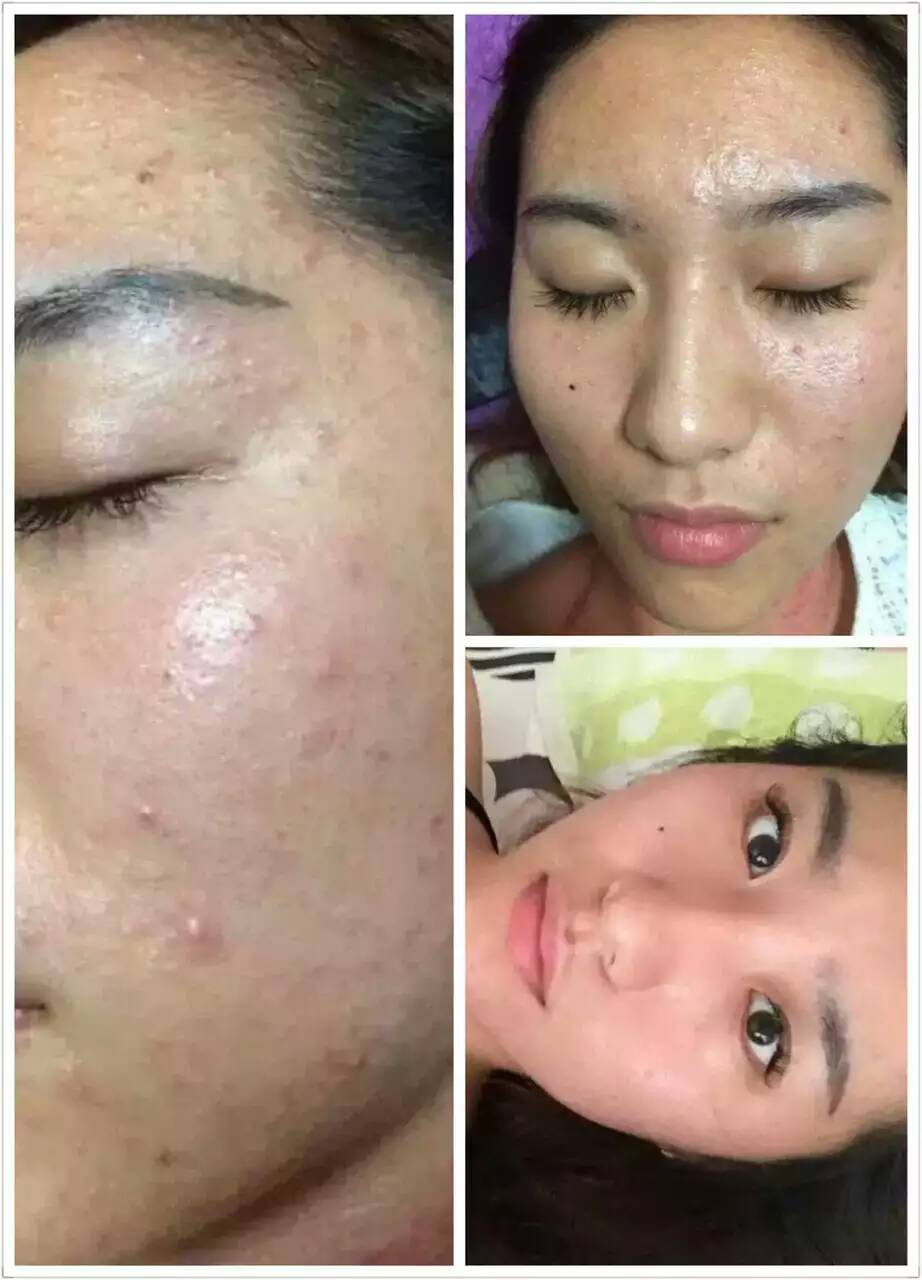 正品消逗宝刺克祛痘 祛粉刺青春痘痤疮黑头-面部精华