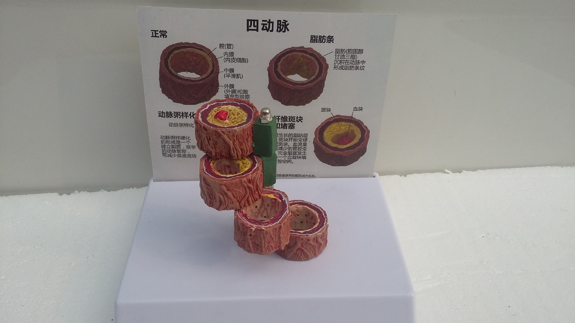 人体支脉粥样硬化 血栓形成模型 血管模型 血液科 动脉硬化模型