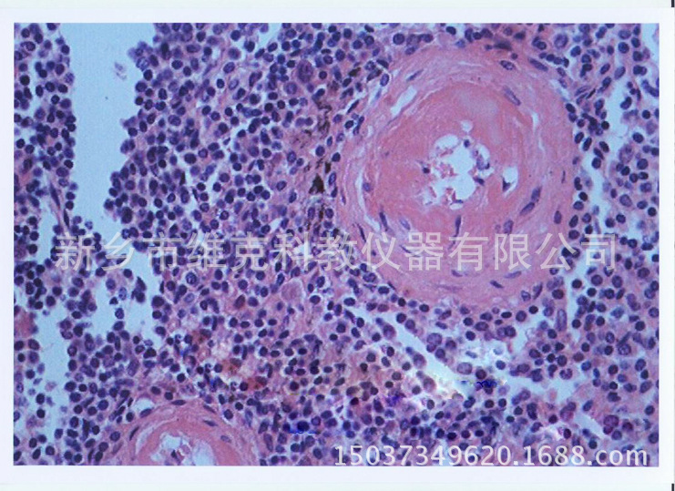 脾中央小动脉玻璃样变性 生物切片 人体病理类 细胞组织损伤修复