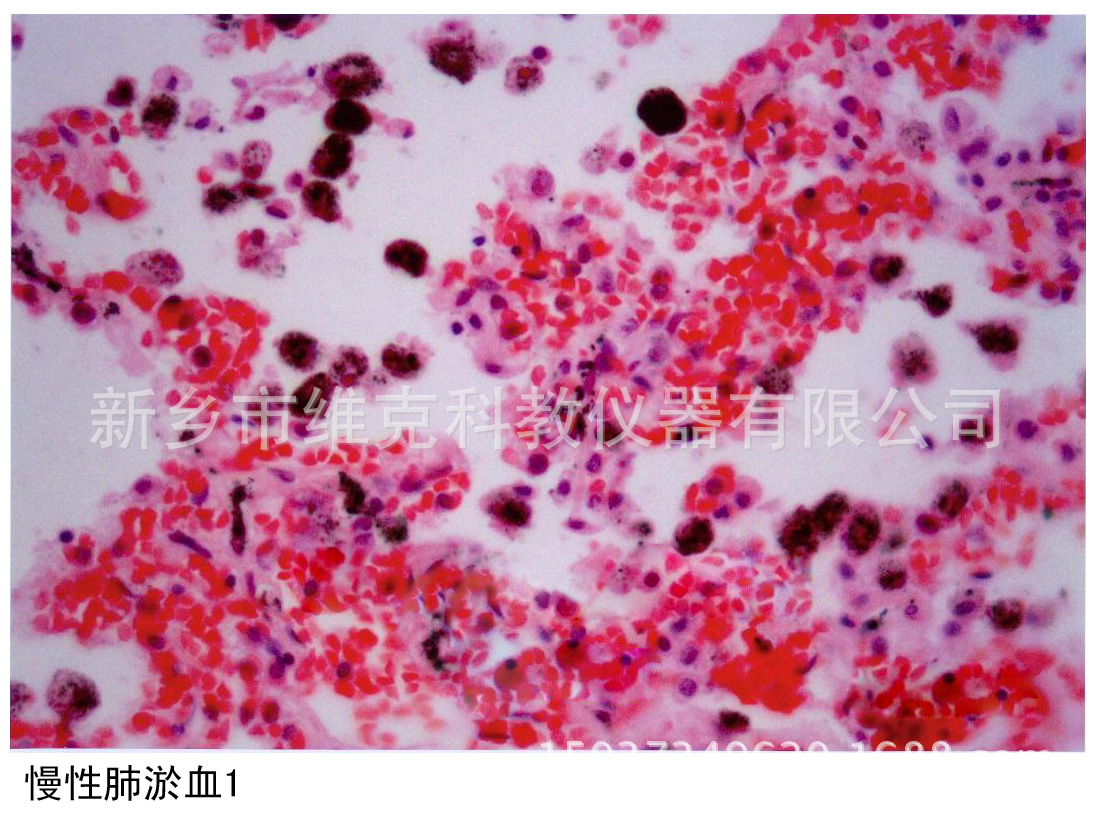 人慢性肺 淤血切片 人体病理学类 局部血液循环障碍 生物教学器材