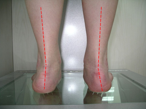 儿童鞋垫 平足内外八字 足内外翻 扁平足 o/x型腿矫正 矫正鞋垫