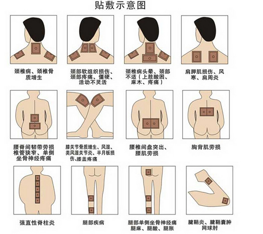 可乐定透贴使用位置图图片