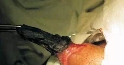 河南男子生殖器突然起火,女友下体惨被烧伤!我伙呆!