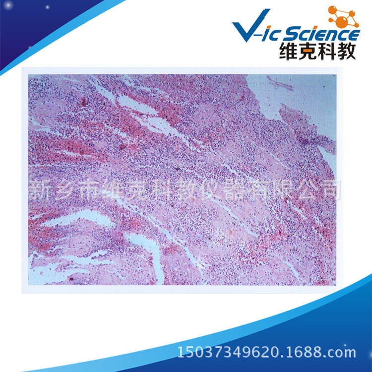 混合血栓切片人体病理学类局部血液循环障碍生物教学器材