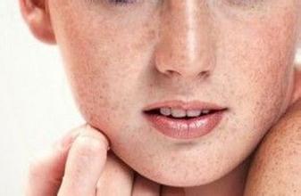 长斑长痘没面子怎么办?我的面子源自内在健康