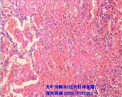 大叶性肺炎(红色肝样变期)