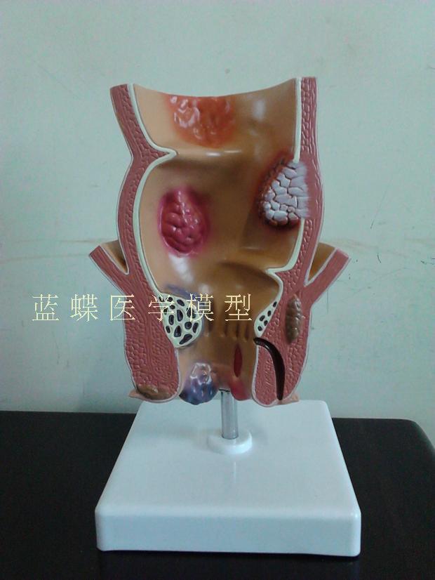 痔疮病变模型 人体直肠病理模型 内痔外痔模型 肛门模型