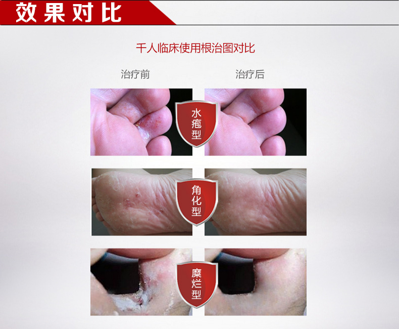 金泰康鞋足部调理乳膏 脚臭脚气喷剂脚痒脱皮水泡喷剂品牌直售