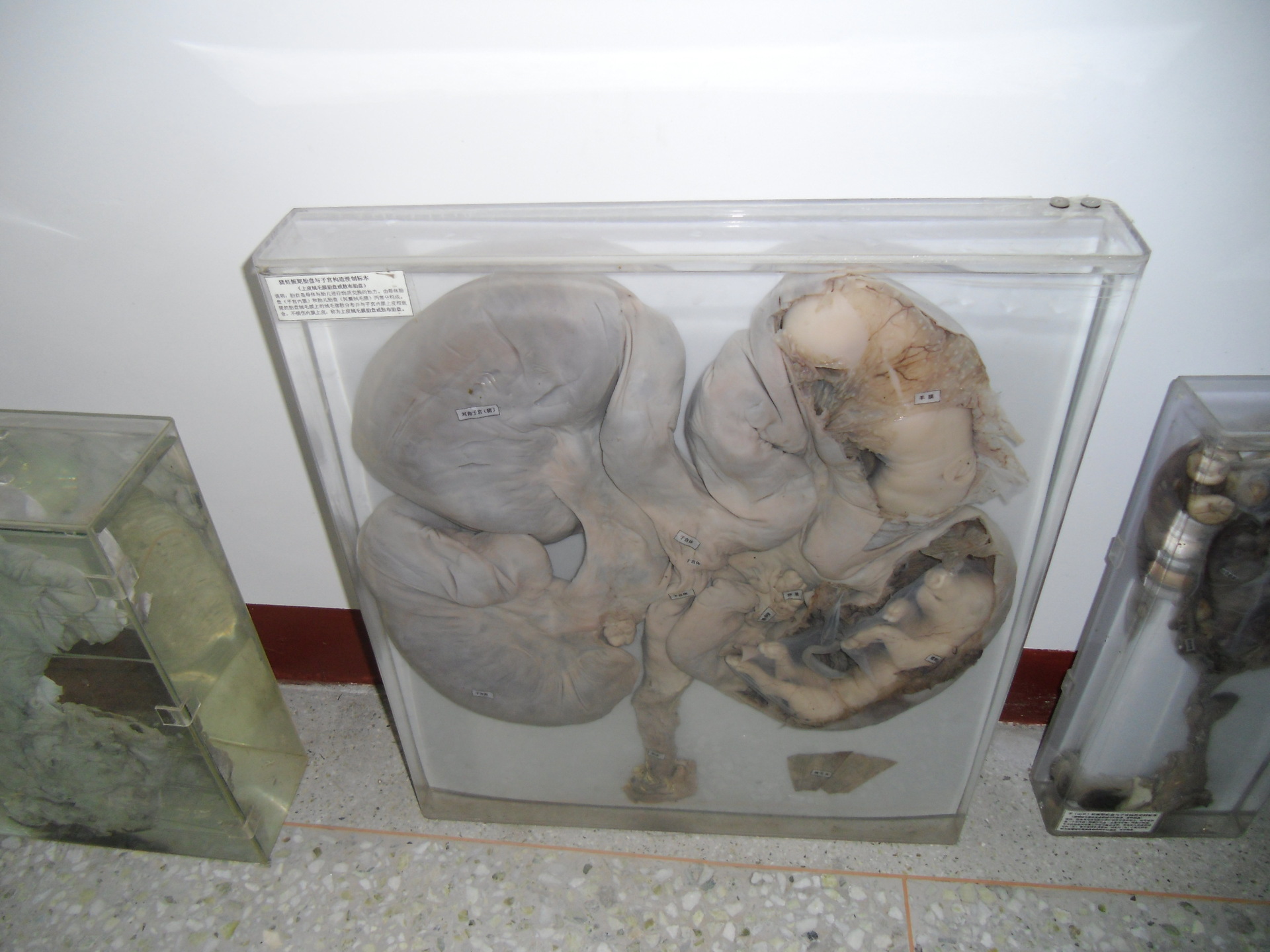 解剖组织病理教学仪器多发性子宫平滑肌瘤标本病理大体大体标本