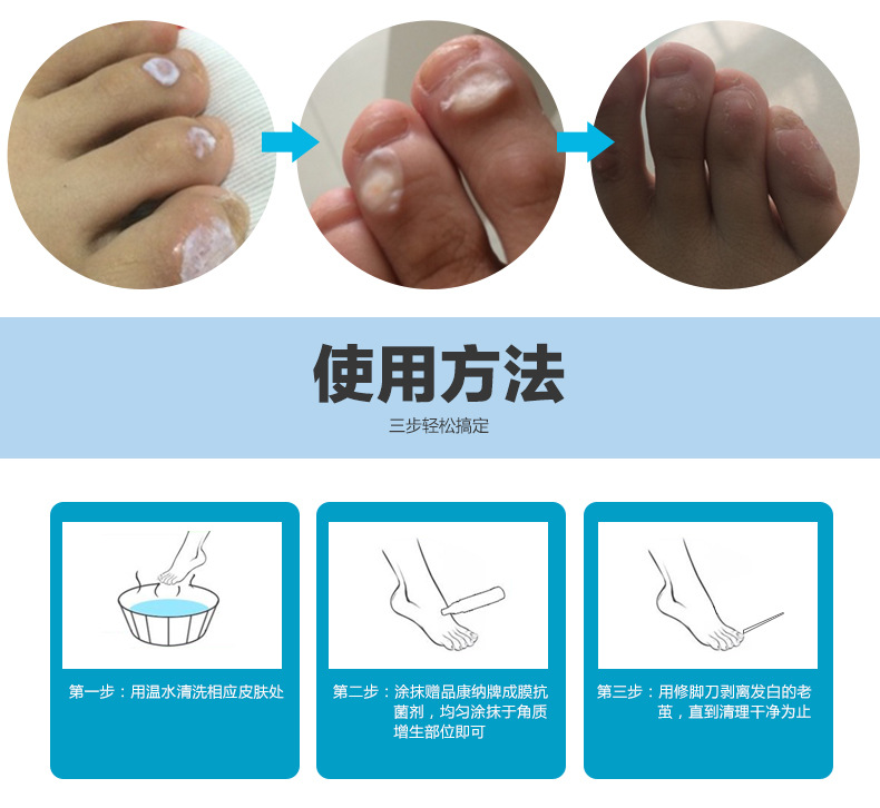 修脚去除脚底老茧脚茧手茧足茧子脚垫净治鸡眼膏贴祛脚趾液鸡眼净
