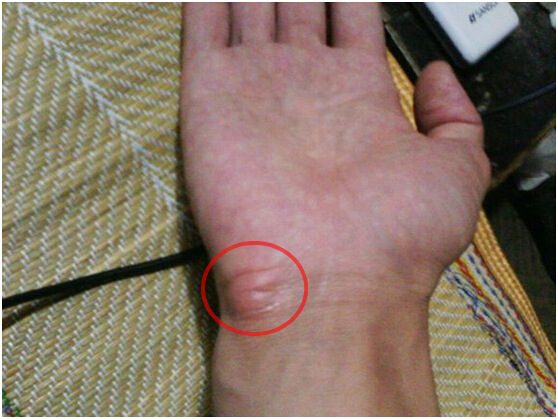 鼠标手让您困扰,为何不提前预防?