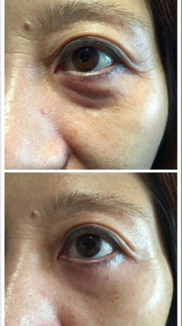 供应快速去皱 去眼袋 去鱼尾纹 黑眼圈