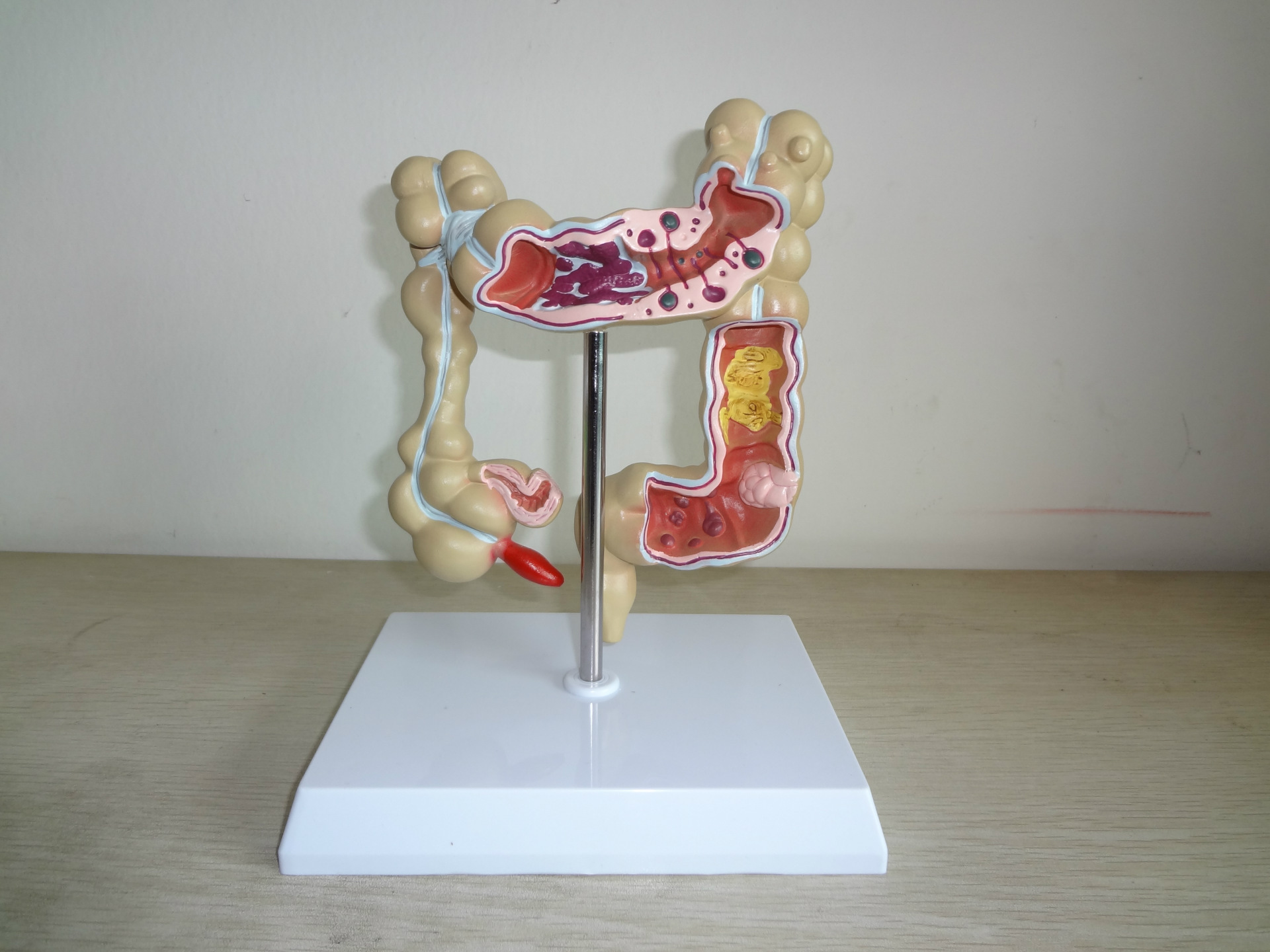 结肠病变模型 结肠息肉 结肠癌 溃疡性结肠炎阑尾炎和肛肠科医患