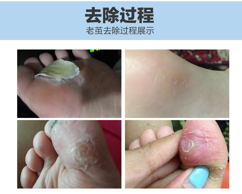 修脚去除脚底老茧脚茧手茧足茧子脚垫净治鸡眼膏贴祛脚趾液鸡眼净