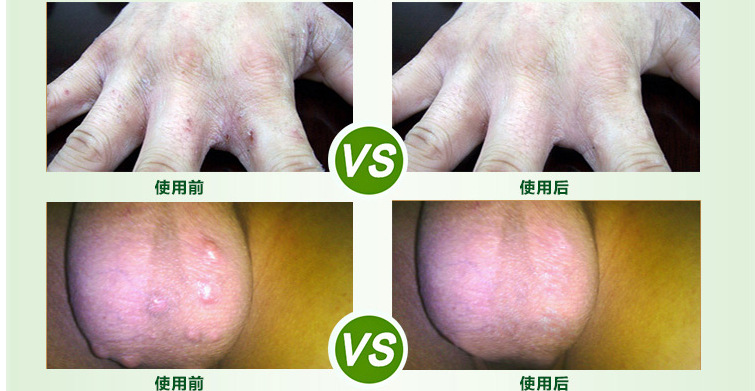 批发虱疥一扫光喷剂 去虱子药头虱阴虱芥疮结节 60ml草本喷雾代发