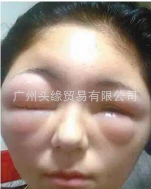 其实,做染发过敏测试很简单:只需取少量染发剂,涂在前臂内侧,如果出现