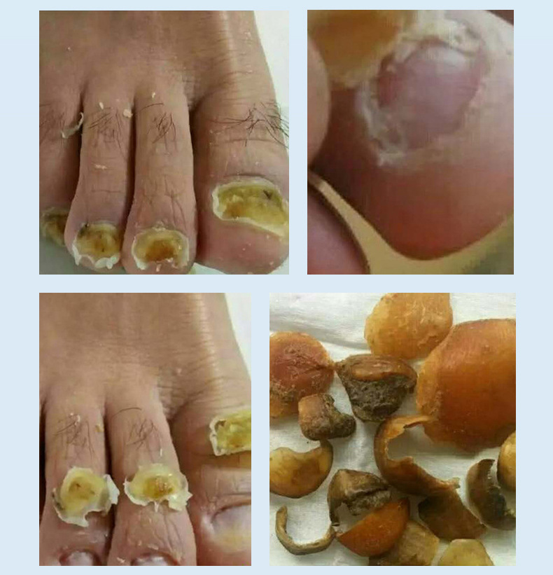 灰指甲脱甲精油 7天脱甲