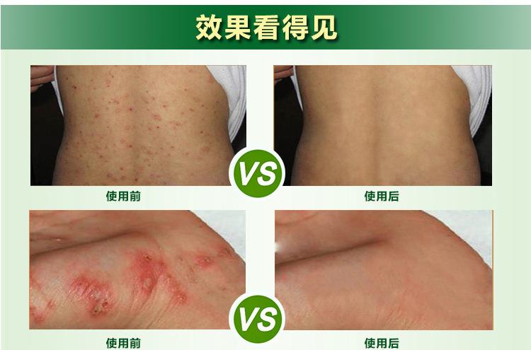 批发虱疥一扫光喷剂 去虱子药头虱阴虱芥疮结节 60ml草本喷雾代发