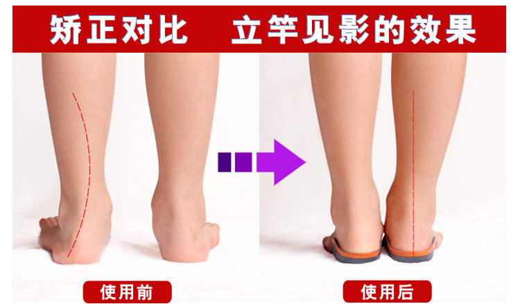 2016年新款儿童扁平足矫正鞋垫 足外翻内外八字矫正 足弓垫矫形垫