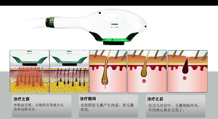 快速脱毛机 ipl脱毛仪 嫩肤祛斑美容院美容仪器