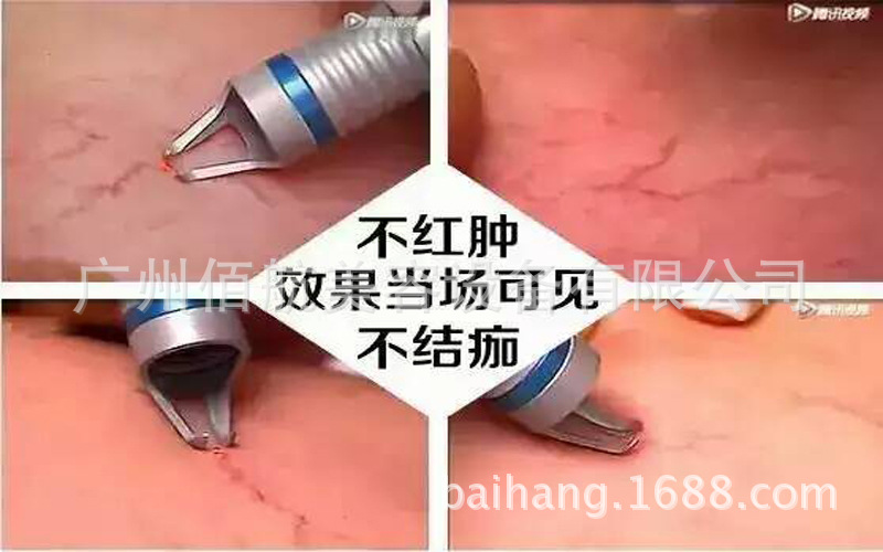 高端仪器_高端980激光净丝仪器 激光 面部祛红