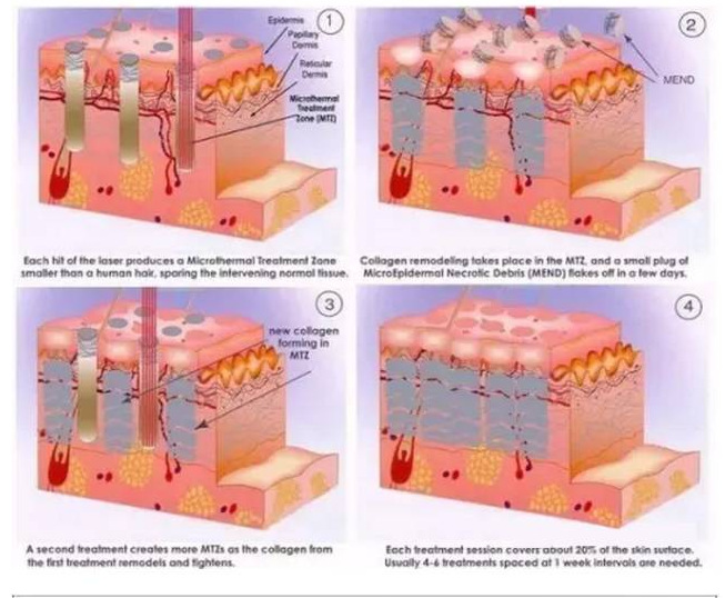 一般来说,只要皮肤正常,无伤口,结痂者,都可以做点阵激光.