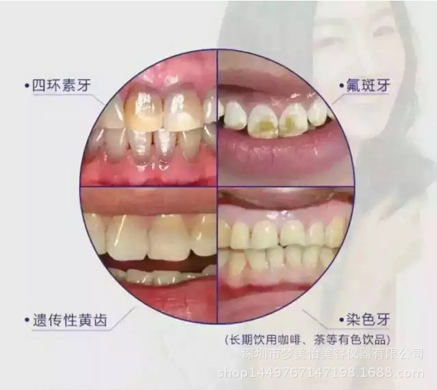 瓜子牙,残缺牙,牙缝过宽,牙釉质发育不全等牙齿问题.