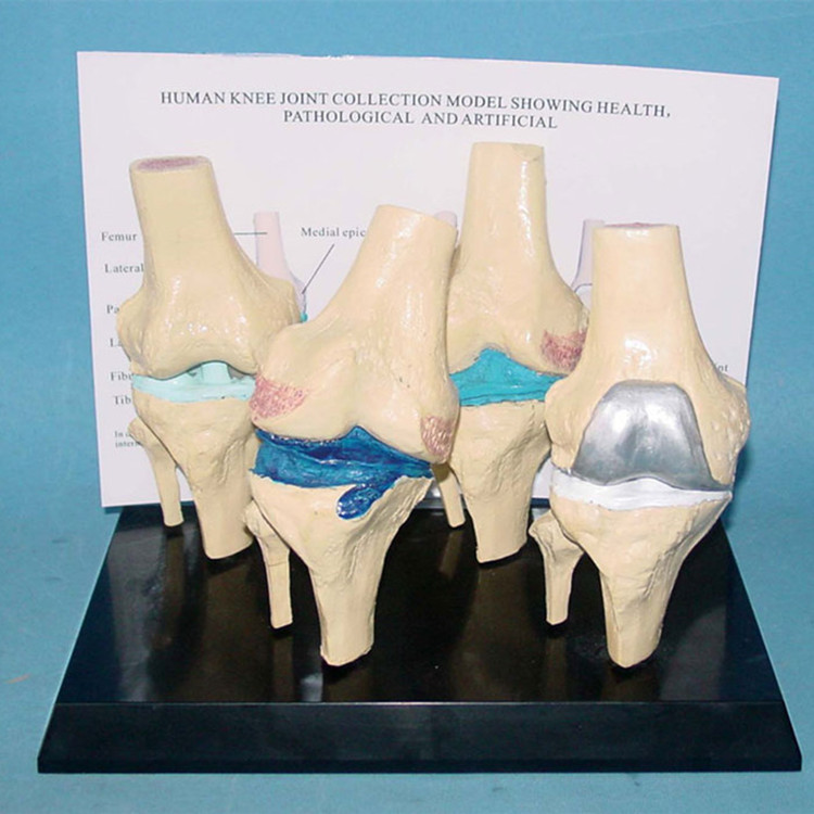 膝关节和病变膝关节比较 模型膝关节病理模型 医用教学用