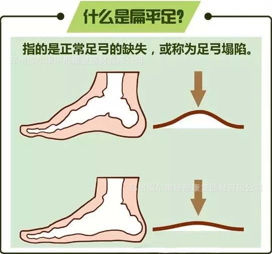 【福尔康矫形知识科普】儿童扁平足矫治与成人有什么不同