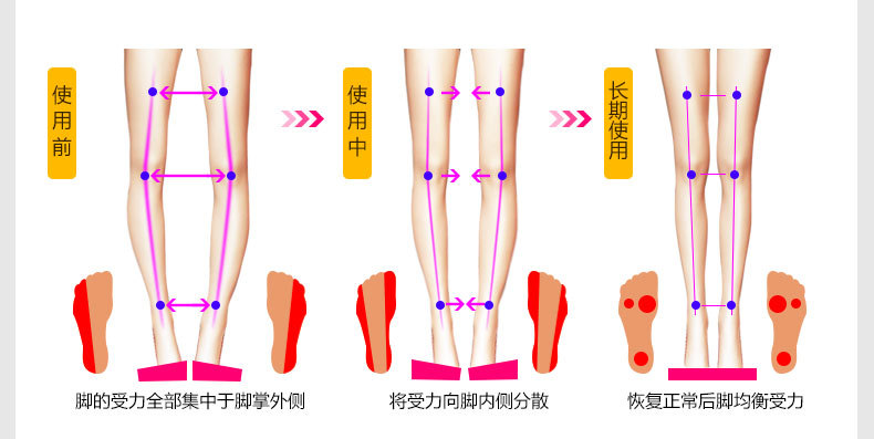 新款 内外八字脚 x/o形腿矫正鞋垫 足外翻矫形护理 罗圈腿矫正 内