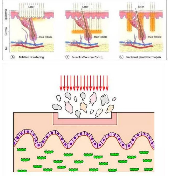 广西co2点阵激光机哪家好二氧化碳点阵激光治疗仪厂家价格