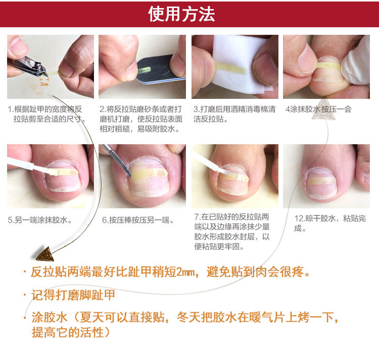 德国进口嵌甲矫正贴片弹片拉拉贴正甲贴反弹片神器反拉贴窄白贴