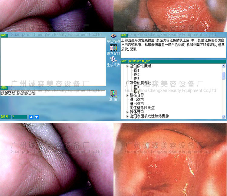 智能高清数码阴道镜内窥镜挂壁式妇科检测仪妇科诊断仪分析仪