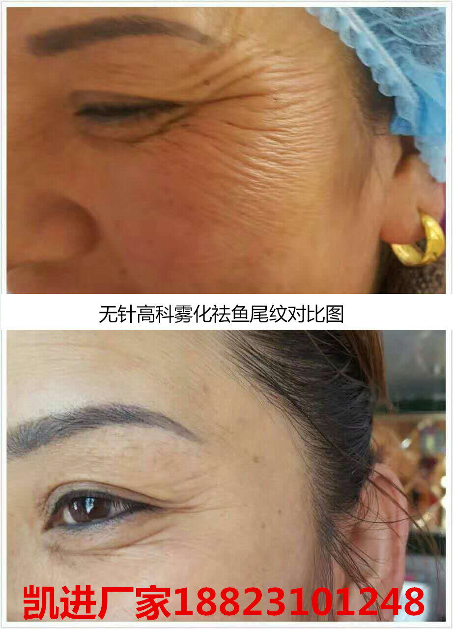 复合多肽雾化微雕祛皱是什么原理?祛皱是肉毒吗?