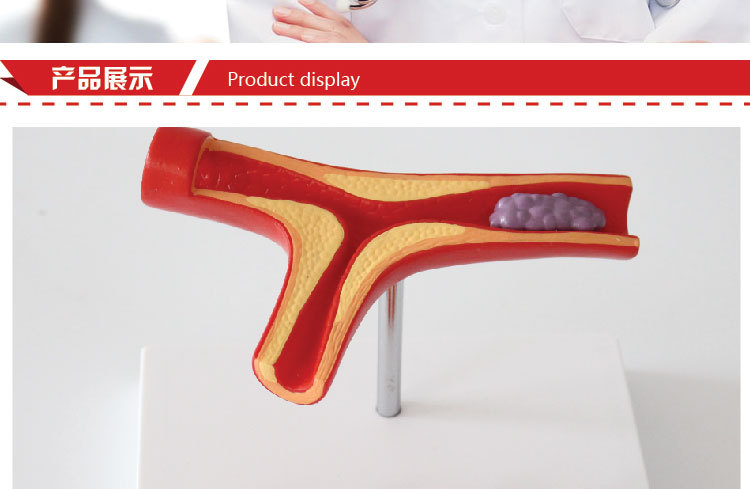 人体y型血管模型心血管粥样硬化 模型 血栓形成演示 动脉硬化模型