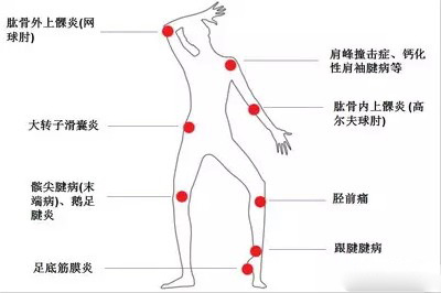 气压弹道冲击波消脂枪理疗仪点阵冲击波疼痛治疗仪消脂减肥仪器厂