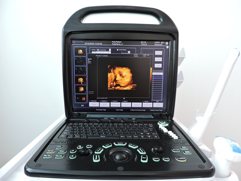 b超无线超声掌上超声便携式超声诊断仪便携式超声掌上彩超掌超