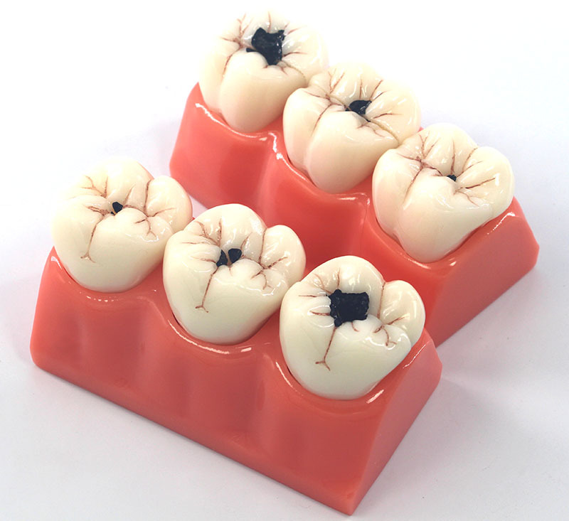 星寿品牌放大3倍龋齿病分解解剖模型 牙齿模型口腔牙保健护理模型