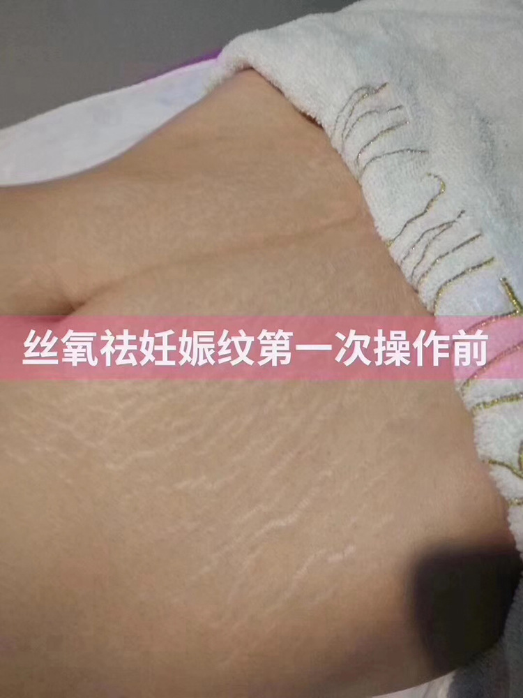 妊娠纹套盒正品丝氧青春焕颜产后修复微针滚针祛大腿生长肥胖纹