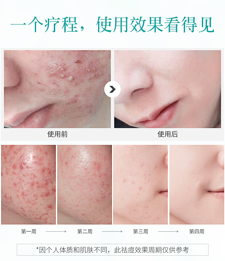 去痘印最有效的偏方_红色痘印和痘坑去不掉_怎么去痘坑痘印