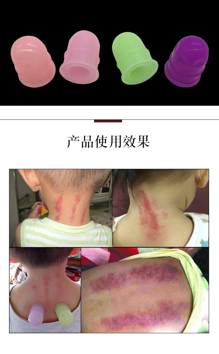 小儿推拿拔罐易罐益罐走罐刮痧出痧快小孩儿童硅胶负压罐软硬可选
