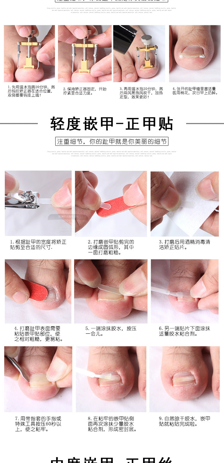 正甲贴脚趾甲矫正器甲沟矫正贴反拉作用嵌甲克星修脚拉拉套装炎