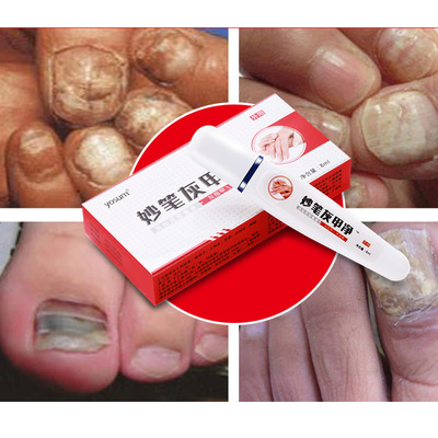 yosum/优香亮甲灰甲净坏甲增厚灰甲清水软灰甲康套装手脚