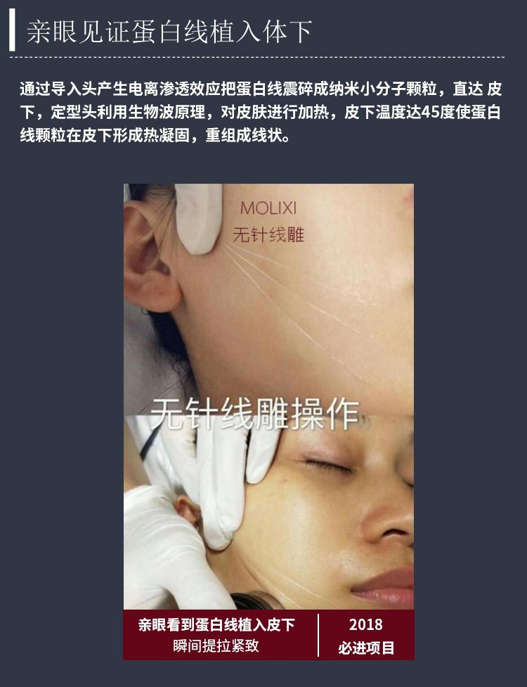 魔力线雷达无针线雕套盒 美容院用脸部微雕v脸蛋白线逆龄组合套装