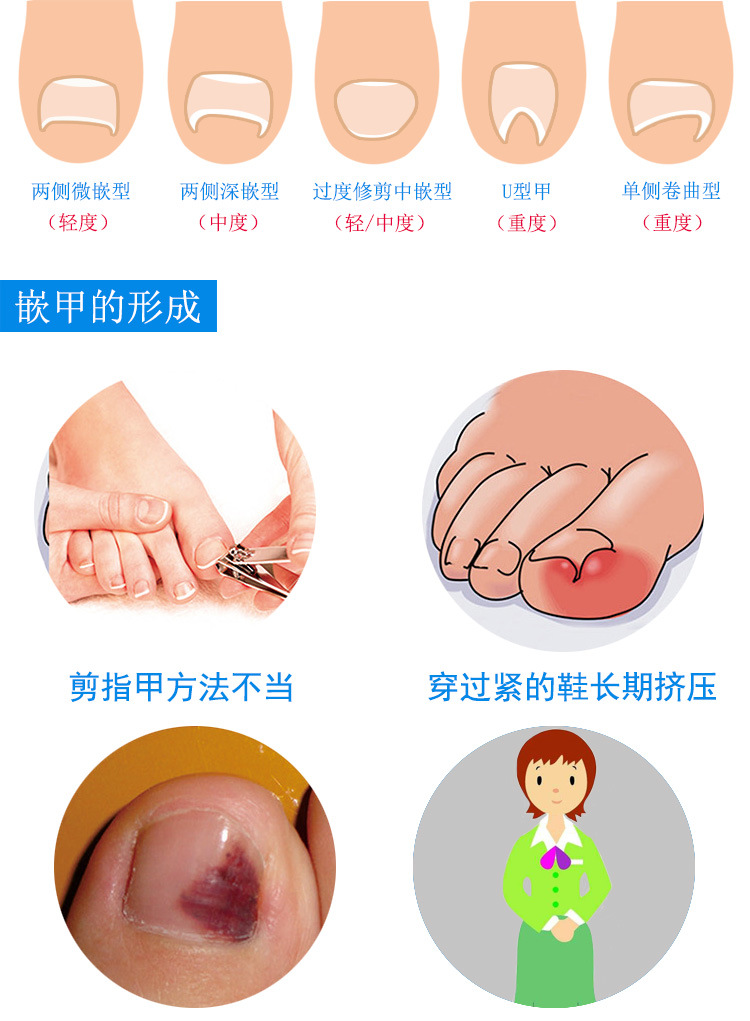 厂家直销甲沟嵌甲矫正器 脚趾甲卷甲矫正丝 脚指甲拉拉物理正甲丝
