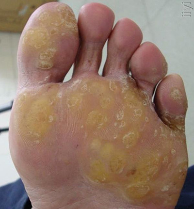 脚底有老茧怎么办?四大方法修复老茧